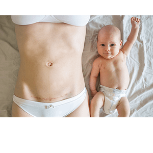 cicatriz cesaresa y bebé